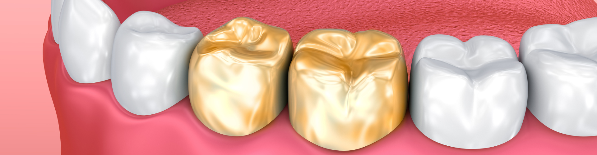 3D representation of a denture with two teeth having gold crowns.